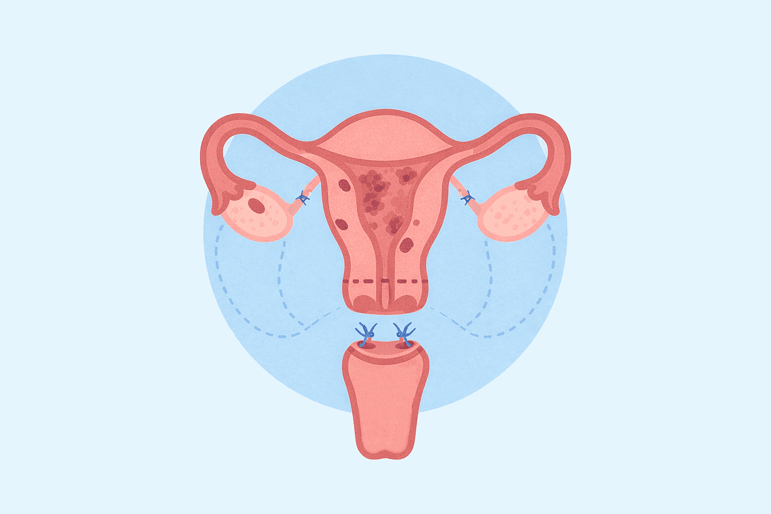 A flat illustration of a hysterectomy, depicting removal of the uterus, fallopian tubes, and ovaries.